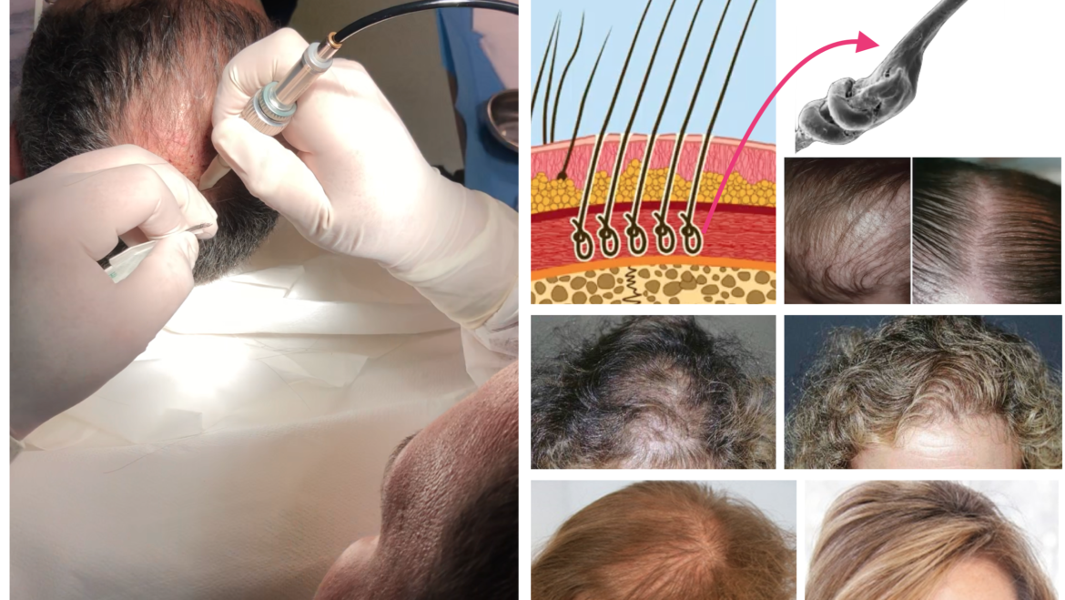El Dr. Bartosz Kosmecki de Clínicas Verkomed es uno de los pocos Médicos en el mundo con entrenamiento reconocido para aplicar FIBRE Hair Implant System ®.